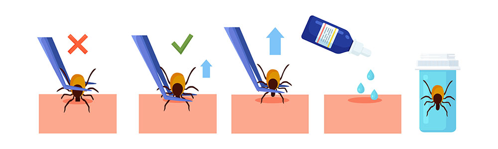 Zecken richtig entfernen