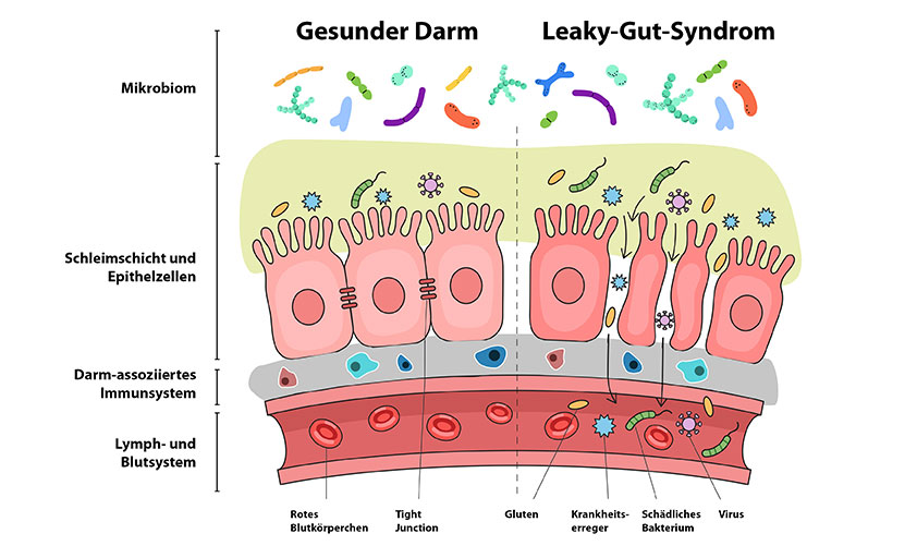 Leaky Gut Syndrom