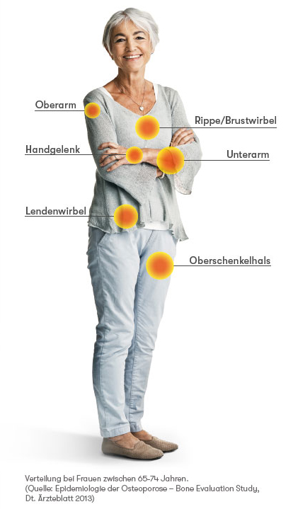 Welche Knochen sind bei Osteoporose besonders gefährdet?