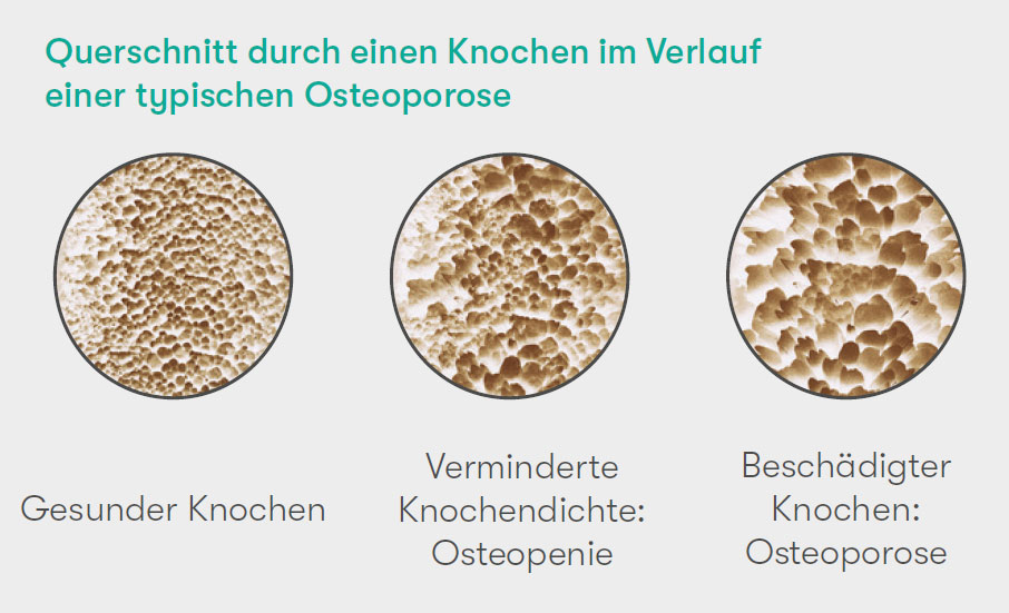 Verminderte Knochendichte bei Osteoporose