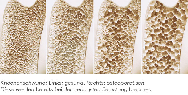 Knochenschwund bei Osteoporose
